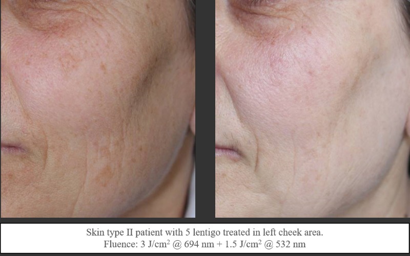 Pigmentation_beforeandafter08
