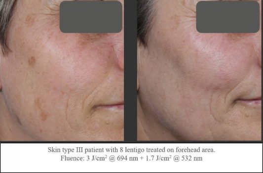 Pigmentation_beforeandafter09