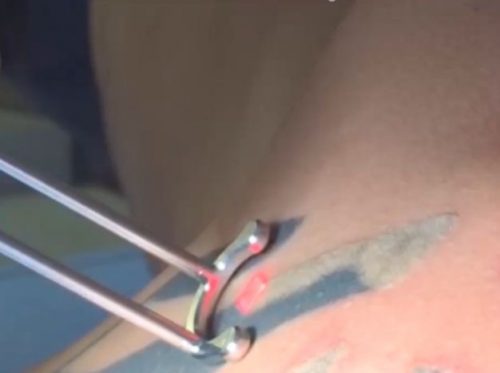 Tattoo image being treated